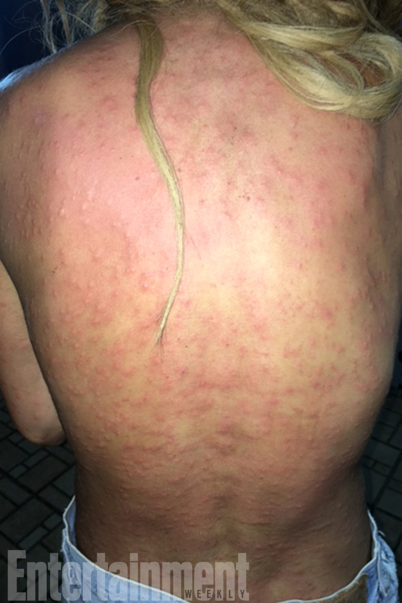 anastasia-ashley-bug-bites1.jpg